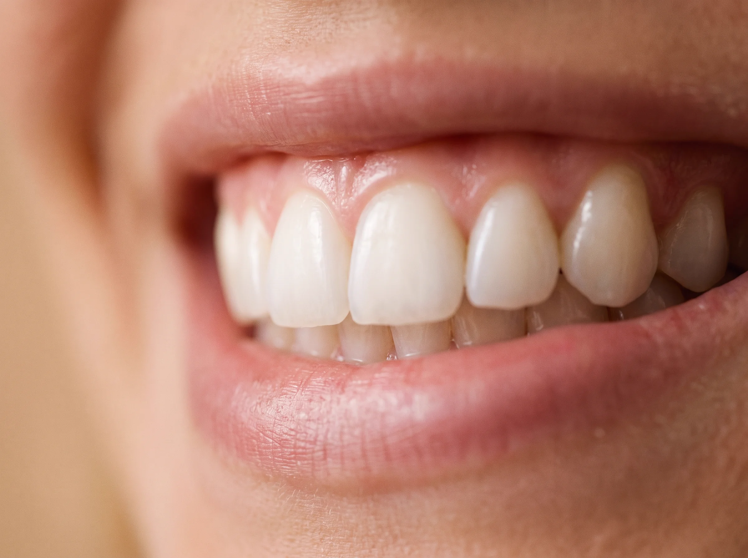 Blanqueamiento dental
